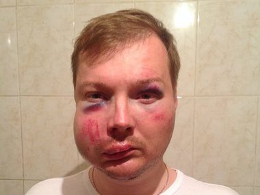 Журналіст, побитий міліцією під Полтавою: Мене вдарили в обличчя прикладом автомата, били ногами, зняли золоті годинники і кільце