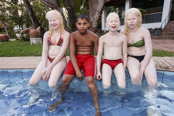 У чорношкірих батьків народилося три білих дитини. Вся справа в рідкісній хворобі- природженому альбінізмі.