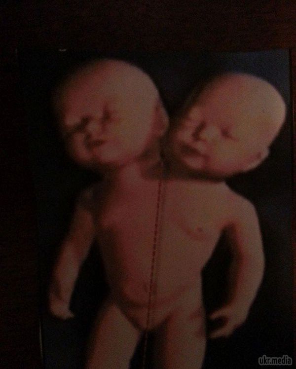У США народилася дитина із двома головами. В Америці народилася унікальна дитина. У малюків дві руки, дві ноги і один тулуб із спільними органами (хоча легенів у них три). Причому особи у близнюків абсолютно різні.