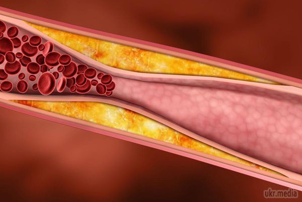 Позбавляємося від "поганого" холестерину і підвищуємо "хороший". Кардіолог розповів, що головні вороги шкідливого ліпопротеїну - здоровий спосіб життя і правильне харчування.