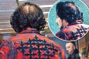 Філіп Кіркоров стрімко втрачає волосся. Проблема чоловічого облисіння торкнулася і короля російської естради Філіпа Кіркорова.