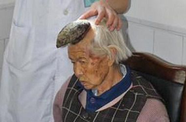 У китаянки через хворобу на голові виріс "ріг". Наріст з'явився сім років тому.