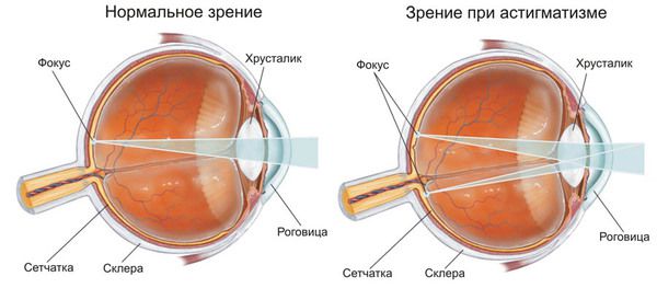 Як лікувати астигматизм.  В перекладі з латинської мови, ця хвороба дослівно перекладається, як "відсутність фокусної точки". На сьогодні астигматизм є досить поширеною хворобою очей. Як лікувати астигматизм, які методи існують і чим вони гарні?