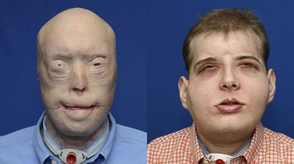Американці зробили найскладнішу пересадку обличчя у світі. В операції брали участь 150 осіб, які працювали протягом 26 годин.