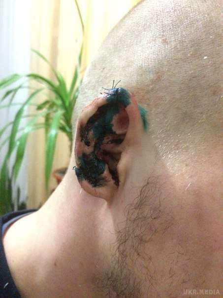 В Херсоні депутат від «Опозиційного блоку» відкусив вухо члену «Азова» (фото). Також нардеп намагався травмувати "азовцу" очі.
