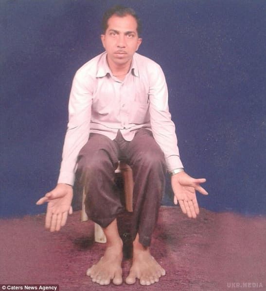 В Індії живе чоловік з найбільшою кількістю пальців на руках і ногах. В Індії чоловік став рекордсменом за кількістю пальців