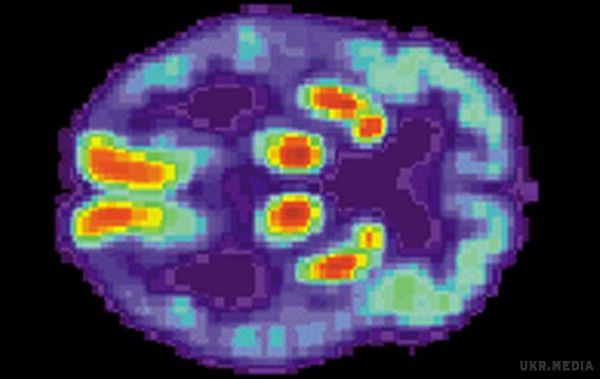 Вчені отримали нові дані про хвороби Альцгеймера. Раннє розпізнавання змін у мозку відкриває нові можливості для лікування.