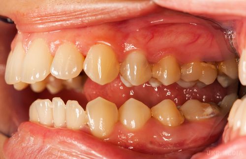 Чому жовтіють  зуби-експерт. Жовтий відтінок зубів далеко не завжди можна пояснити курінням чи зловживанням кави, причиною цьому можуть бути багато інших чинників, 