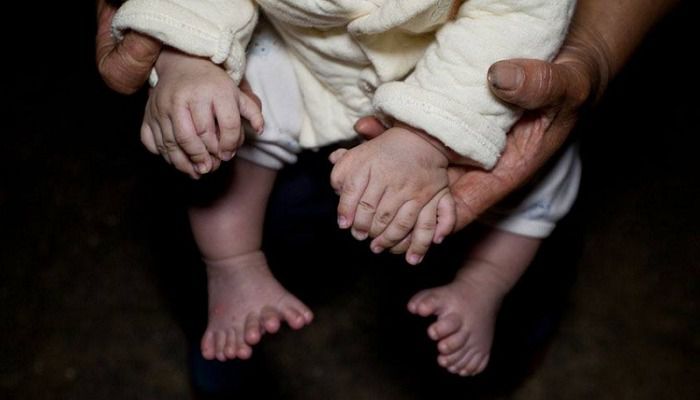 Китайському хлопчику збираються ампутувати 11 лишніх пальців (ФОТО). У Китаї хлопчику, який народився з 31 пальцем на руках і ногах, збираються ампутувати лишні кінцівки. 