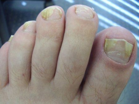 Як і чим вилікувати запущений грибок пальців і нігтів на ногах?. Нерідко у людей виникає питання, як лікувати грибок на ногах.