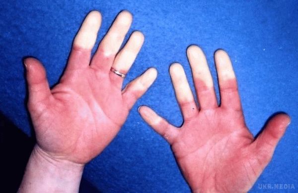 Холод в руках і ногах може свідчити про серйозну хворобу - фахівці. Якщо ваші руки і ноги німіють і замерзають при найменшому похолодання, значить, з вашим здоров'ям щось не так.