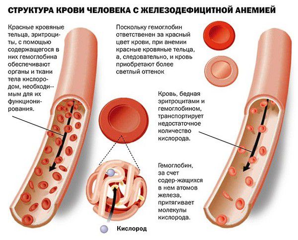 Дефіцит заліза в організмі: симптоми і лікування. Залізодефіцитну анемію можна вилікувати на ранніх стадіях.