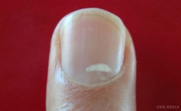 Якщо ви бачите ці ознаки на ваших нігтях, негайно зверніться до лікаря.  Ці точки також можуть бути успадковані, але іноді вони можуть бути пов'язані з більш серйозною проблемою зі здоров'ям.