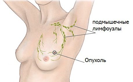 Напій, який ми п'ємо щодня, викликає рак. Рак молочної залози вважається надзвичайно поширеним захворюванням в наші дні. 