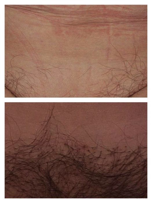 Медики провели першу операцію жінці з пересадки волосся в зону бікіні. Лондонська клініка трансплантації волосся, яка спочатку була створена для чоловіків, відкрила для себе новий напрям. Їх сервіс тепер надає таку операцію для жінок, як трансплантація волосся в зону бікіні.