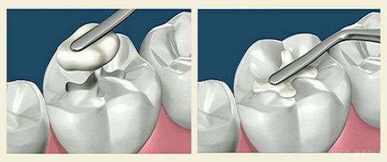 Це просто неймовірно! Вчені винайшли вічну пломбу, яка сама буде лікувати зуб!.  За словами винахідників, така пломба не тільки буде захищати зуб від руйнування, але і лікувати від карієсу! 