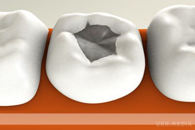 Це просто неймовірно! Вчені винайшли вічну пломбу, яка сама буде лікувати зуб!.  За словами винахідників, така пломба не тільки буде захищати зуб від руйнування, але і лікувати від карієсу! 