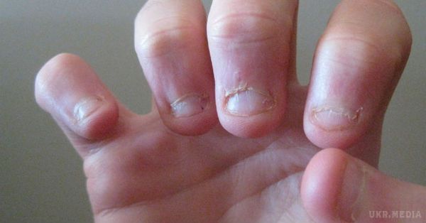 Вчені з'ясували, що об'єднує людей, які гризуть нігті. Люди вважають, що обкусані нігті – показник занепокоєння.
