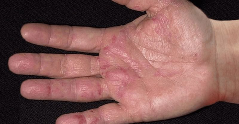 Перші симптоми раку -  існує одна загальна ознака і пов'язана  з вашими руками!.  Існує один симптом, який може попередити вас про наявність будь-якого з видів цієї страшної хвороби? 
