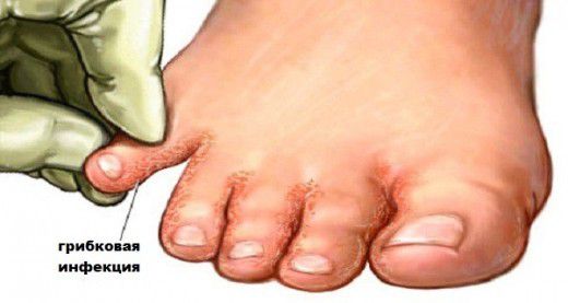 Попрощайтеся з грибковими інфекціями: замочуйте свої ноги в ... Найчастіше влітку наші ноги потіють, і це збільшує ймовірність розвитку грибкових інфекцій в області пальців ніг. 