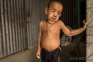 В Індії 21-річний хлопець володіє тілом 165-літнього старця. 21-річний чоловік з Індії страждає рідкісним генетичним захворюванням. 