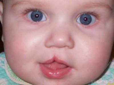Вчені розповіли, чому при народженні з'являється заяча губа. Пояснити природу появи дітей з заячою губою вчені намагаються довгі роки.