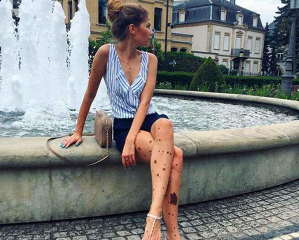 В Instagram зіркою стала дівчина з рідким захворюванням (Фото). 26-річна Юліана Юссеф з Варшави, Польща, страждає від вродженої меланоцитарного невуса.