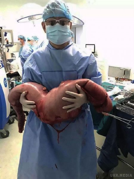 Мережа шокували знімки з операції по видаленню 76-сантиметрової пухлини товстої кишки. У Китаї 22-річному чоловікові видалили 76-сантиметрову пухлина, яка сформувалася в результаті хвороби Гіршпрунга.