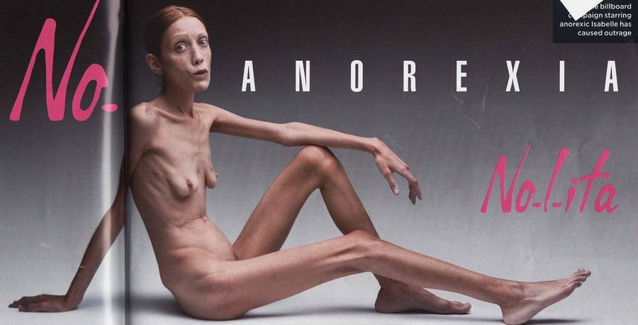 Медики назвали 5 страшних ознак анорексії. Термін «анорексія» вперше був вжитий ще 200 років тому.