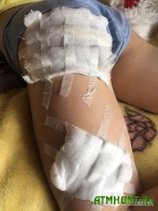 У Сумській області лисиця напала на маленьку дівчинку. Дитина перебуває в лікарні з травмами від укусів хижака, вакцину від сказу довелося шукати батькам.