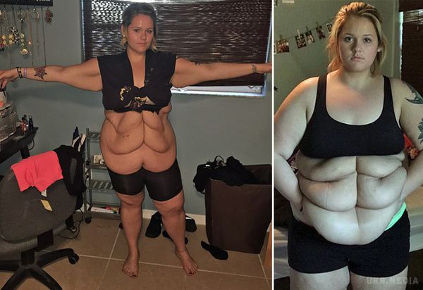 Американка схудла на 80 кілограмів і поділилася фото. 6 пакетів зайвої шкіри.