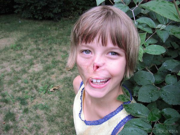 Дівчинці, яка стала жертвою укусу домашнього єнота, відновлюють обличчя. Життя 14-літньої дівчинки з самого дитинства схоже на пекло.