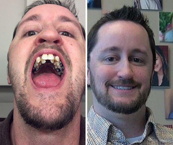 40 дивовижних випадків, коли стоматологи творили чудеса. Як же пощастило тим щасливчикам, у яких з народження рівні і красиві зуби.