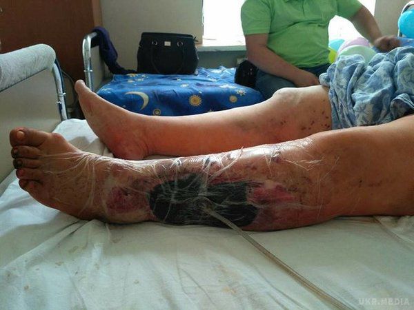 Подробиці потужного вибуху в київській маршрутці. Ногу жінки похилого віку розірвало до кістки.