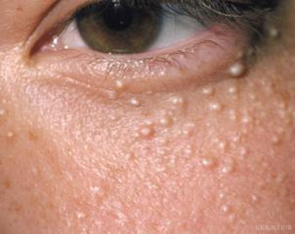 Білі вугри на шкірі (просянка) - причини появи та методи усунення. Найчастіше міліуми з'являються на обличчі (навколо очей, на повіках, щоках).