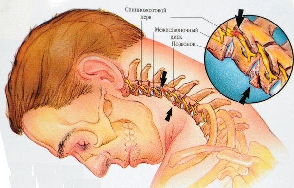 Біль в області шиї і потилиці піде за 10 секунд(відео).  Біль в шиї може виникнути в результаті запалення або переохолодження. 