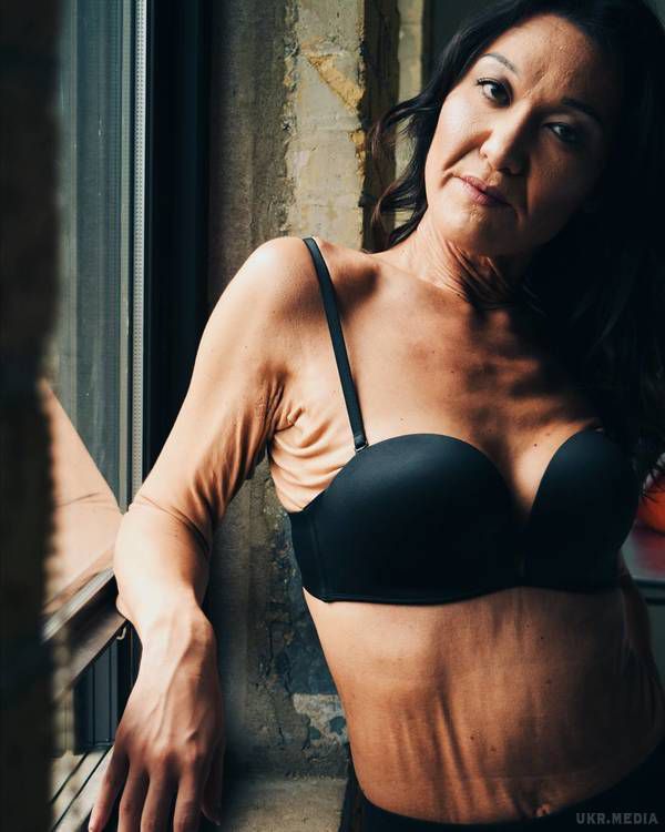 26-річна модель із рідкісною хворобою шкіри вразила світ. Шокуючі фото. Сара Герц у свої 26 років страждає невиліковним захворюванням – синдромом Елерса-Данлоса.