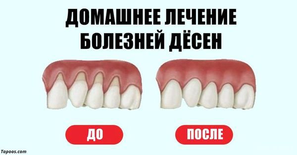 10 найбільш ефективних домашніх засобів для лікування ясен. У вас бувають такі проблеми, як розпухлі ясен, підвищена чутливість і неприємний запах з рота? 