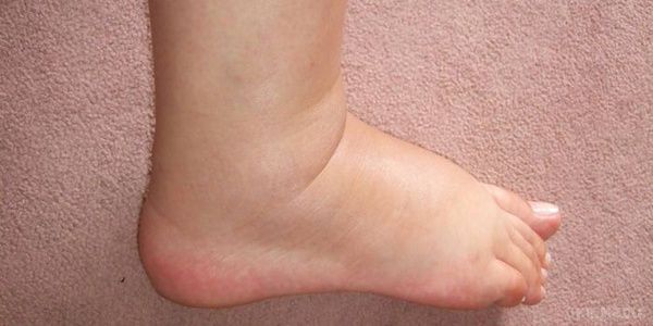 Чому сильно опухають ноги, що робити, лікування – популярно про здоров'я. Чому сильно опухають ноги, що робити, лікування.