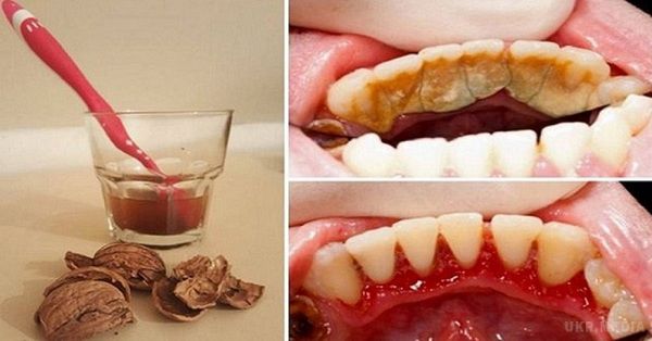 Зубний камінь - проблема та способи вирішення