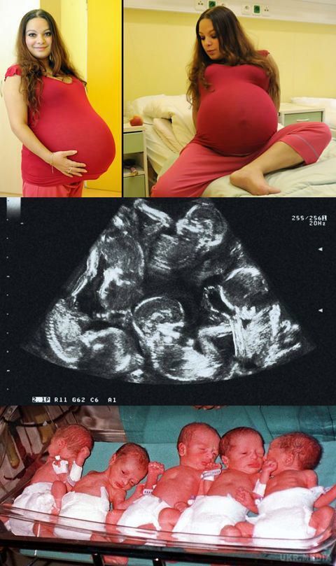 Коли дівчина завагітніла, вона і не підозрювала, що стане героїнею своєї країни. Вона перша чеська мама, яка народила відразу п'ятьох близнят.