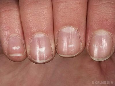 Темні смужки на нігтях — страшна ознака! Онкологи попереджають... Справа в тому, що нігті — не тільки функціональна одиниця, яку можна прикрасити по своєму смаку. Вони — індикатор твого здоров'я.