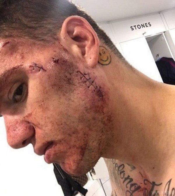 З'явилося фото обличчя воротаря "МанСіті" після страшної травми. Едерсону наклали шви після удару шипами бутси по голові.