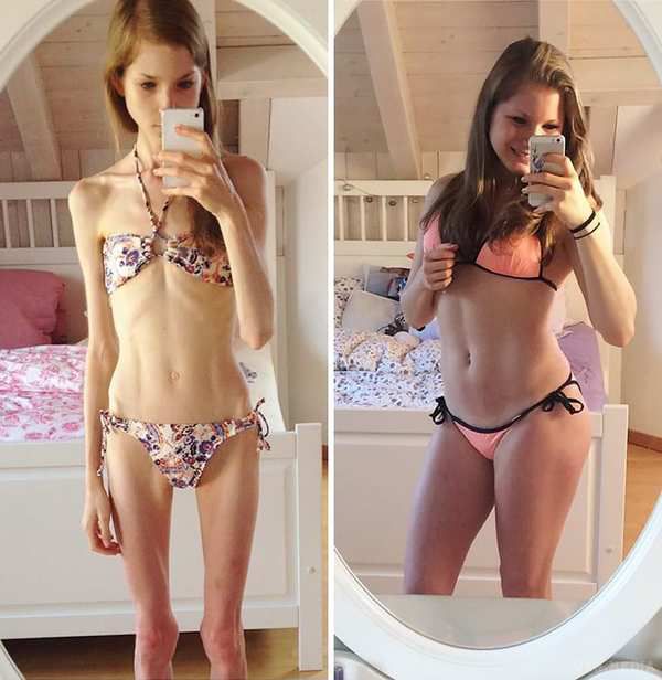 Чудові знімки людей, які перемогли анорексію (Фото) - До і після. Приклади чудесного відновлення людей, страждаючих анорексією.
