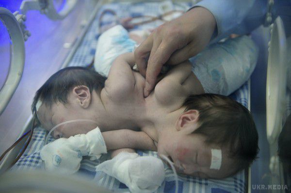 Індійські лікарі не можуть визначити стать новонароджених сіамських близнюків. Діти, які зрослися в районі живота і геніталій, мають кожен свої життєво важливі органи, але не можуть повноцінно розвиватися поки не будуть роз'єднані.
