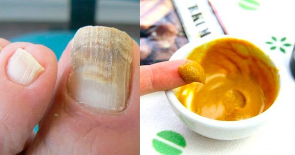 Мікоз нігтів швидко і просто можна вилікувати за допомогою куркуми та кокосової олії. Є натуральні засоби, які допоможуть ефективно вилікувати грибок нігтів природним шляхом. 