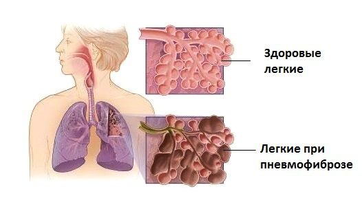  Пневмофіброз легких: дихальна гімнастика.  При пневмофіброзі легких є дихальні вправи.