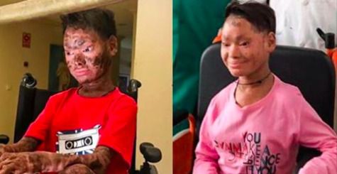 Дівчинку, з якою кожні 6 тижнів злазила шкіра, в Європі вилікували за 10 днів. 16-річна Шалини Ядав з Індії страждає важким вродженим захворюванням — ламеллярним іхтіозом.