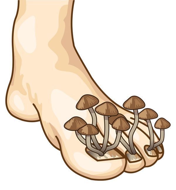 Грибок відсохне з коренем! Візьми та намаж ноги звичайною ... Поки у грибка, що живе в твоєму організмі, є живильне середовище, він буде розмножуватися....