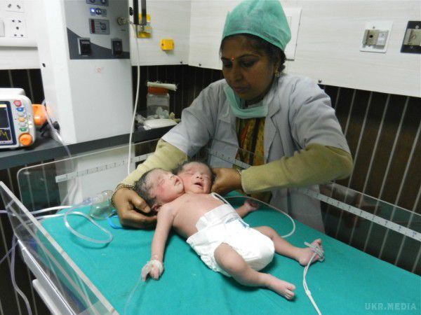В Індії з'явилася на світ дитина з двома головами. Ця аномалія була діагностована у матері на пізньому терміні, але жінка відмовилася переривати вагітність, вирішивши виносити плід до кінця.